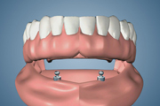 Ball Attachment with 2 Implants